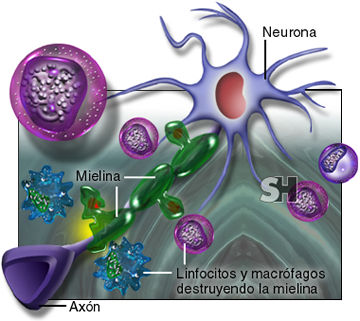 esclerosis multiple